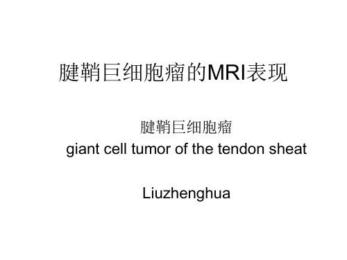 2019年《腱鞘巨细胞瘤》ppt课件.ppt