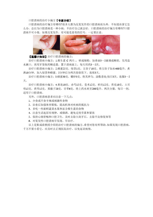 口腔溃疡的治疗小偏方【专家介绍】