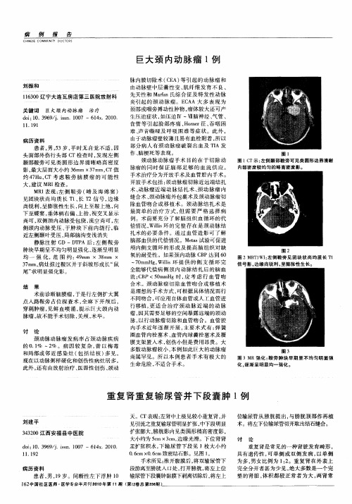 巨大颈内动脉瘤1例