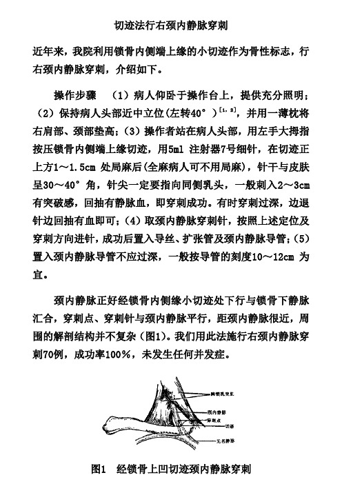 切迹法行右颈内静脉穿刺