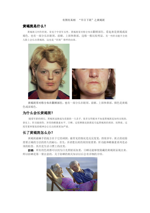 早日“下斑”之黄褐斑