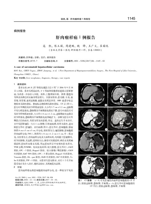 肝肉瘤样癌1例报告 寇凯