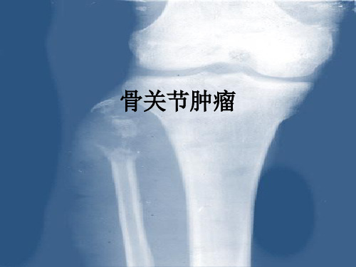 骨关节肿瘤ppt课件