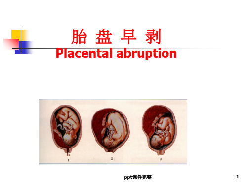胎盘早剥_PPT课件