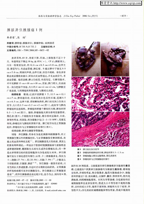 脾脏异位胰腺癌1例