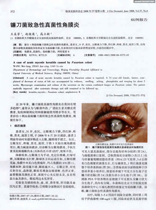 镰刀菌致急性真菌性角膜炎