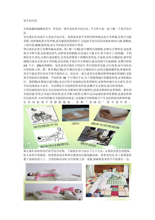 肩手综合征