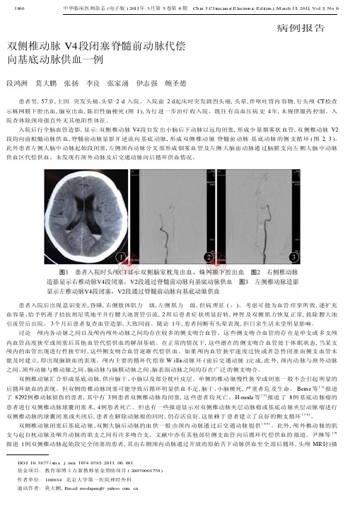 双侧椎动脉V4段闭塞脊髓前动脉代偿向基底动脉供血一例