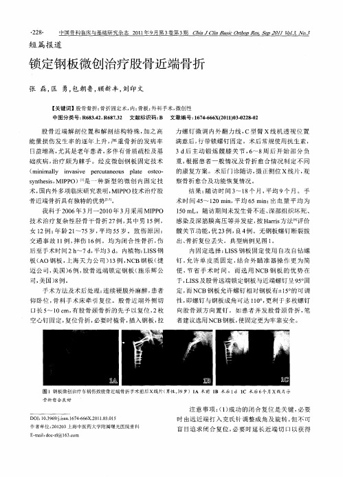 锁定钢板微创治疗股骨近端骨折