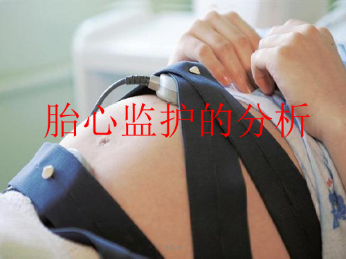 胎心监护演示文稿