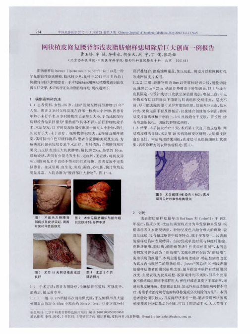 网状植皮修复腰背部浅表脂肪瘤样痣切除后巨大创面一例报告