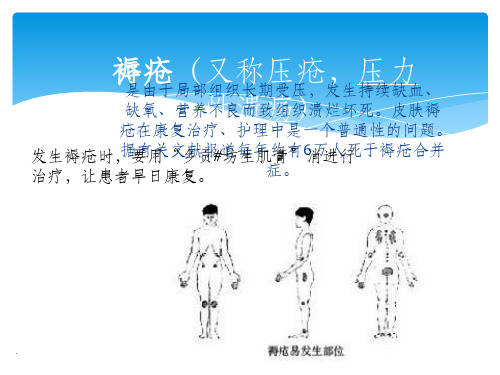 治疗褥疮最好的药