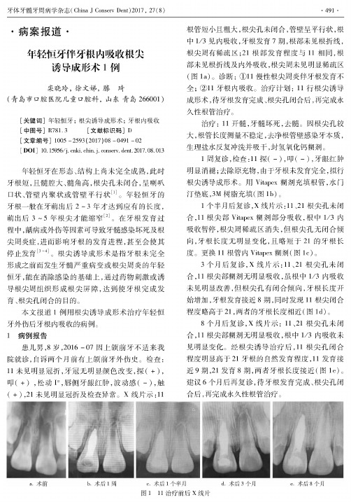 年轻恒牙伴牙根内吸收根尖诱导成形术1例