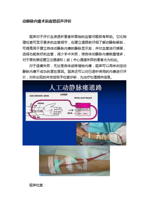 动静脉内瘘术前血管超声评价