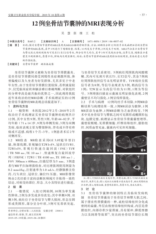 12例坐骨结节囊肿的MRI表现分析
