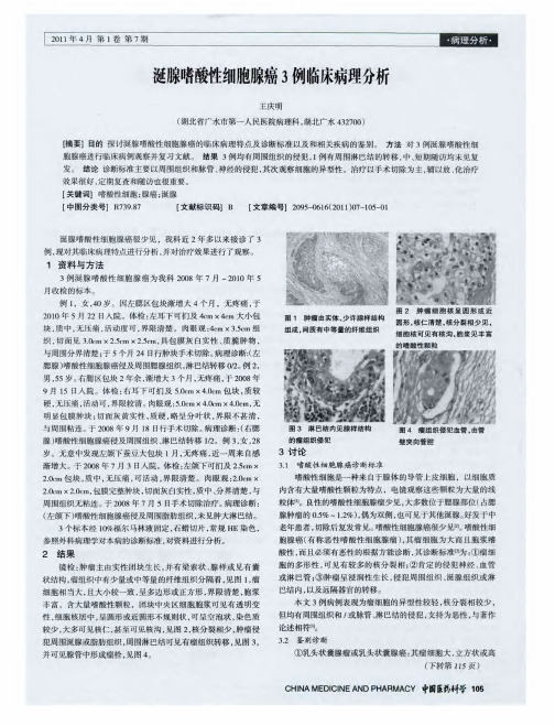 涎腺嗜酸性细胞腺癌3例临床病理分析