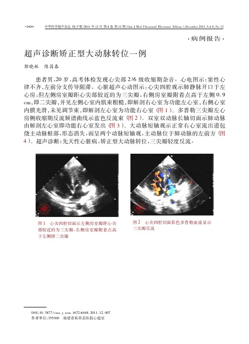 超声诊断矫正型大动脉转位一例