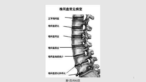 腰椎间盘突出症诊治PPT课件详解PPT课件