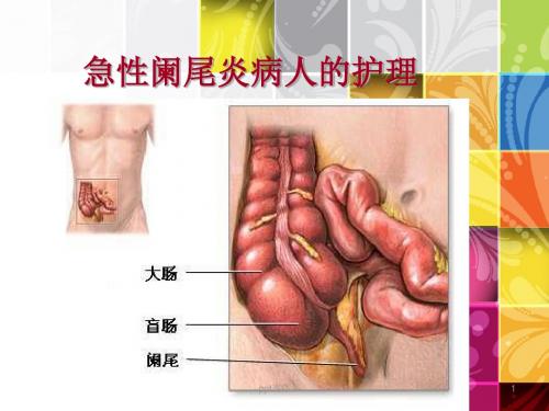 急性阑尾炎病人的护理   ppt课件