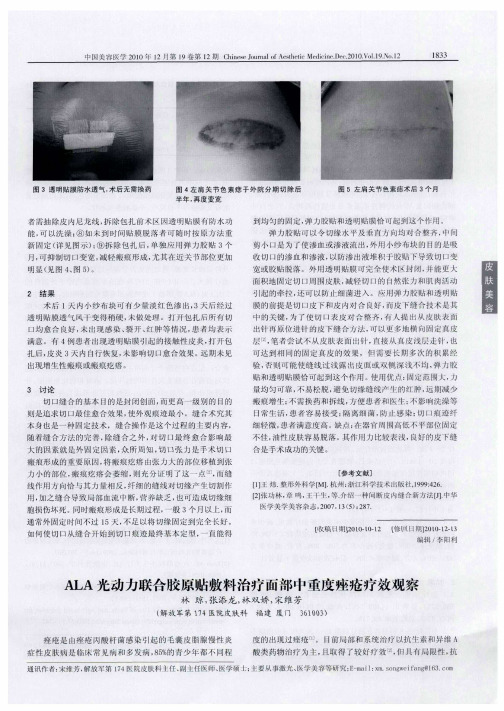 ALA光动力联合胶原贴敷料治疗面部中重度痤疮疗效观察