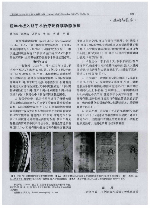 经半椎板入路手术治疗硬脊膜动静脉瘘