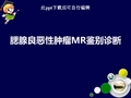 腮腺良恶性肿瘤MR鉴别诊断ppt课件