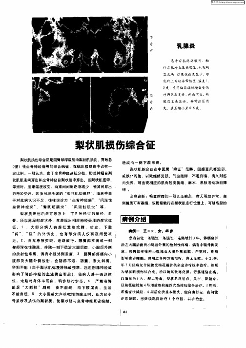 梨状肌损伤综合征