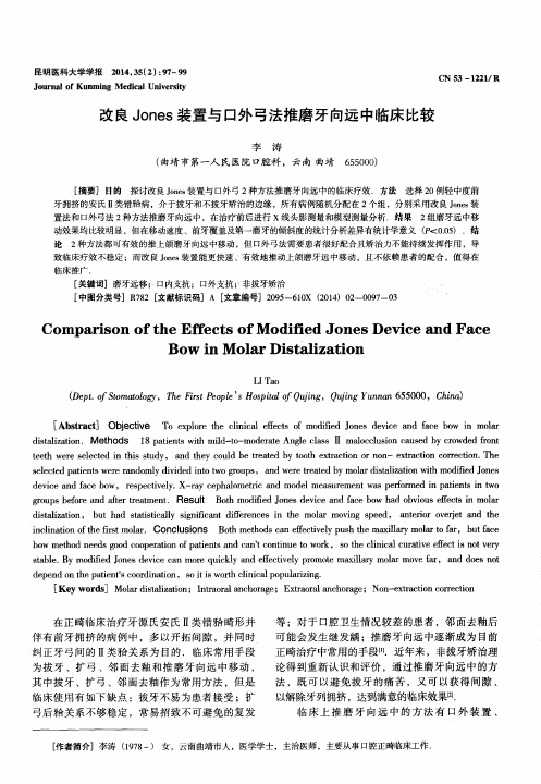 改良Jones装置与口外弓法推磨牙向远中临床比较
