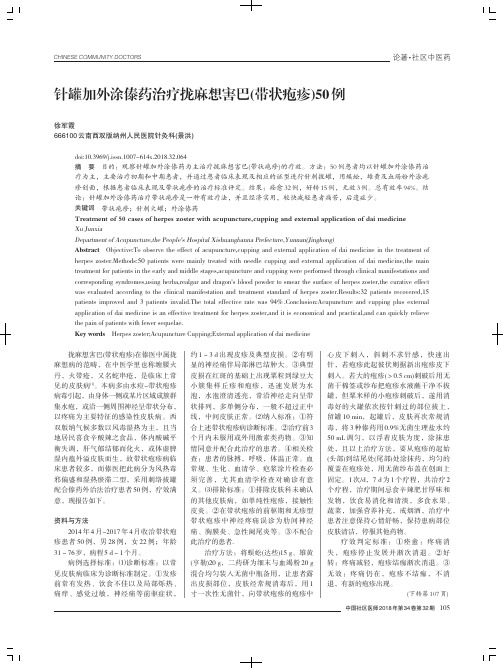 针罐加外涂傣药治疗拢麻想害巴(带状疱疹)50例