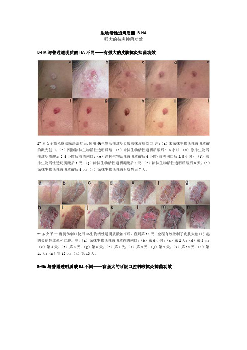 生物活性透明质酸B-HA——强大的抗炎抑菌功效