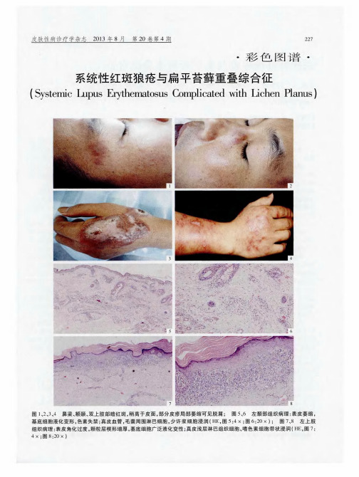 系统性红斑狼疮与扁平苔藓重叠综合征