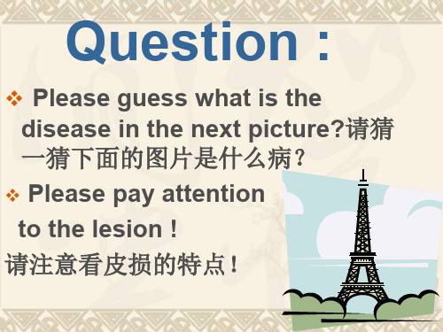 带状疱疹课件讲课教案
