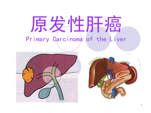 原发性肝癌ppt课件
