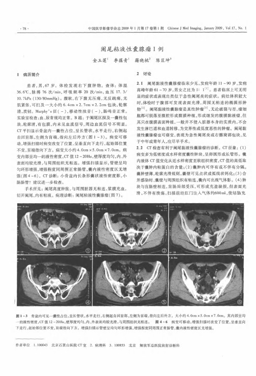 阑尾粘液性囊腺瘤1例
