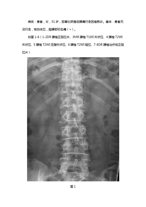 腰4椎体楔形变胸12椎体异常信号改变--压缩性骨折