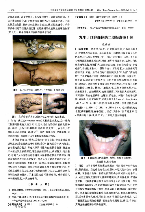 发生于口腔部位的二期梅毒疹1例