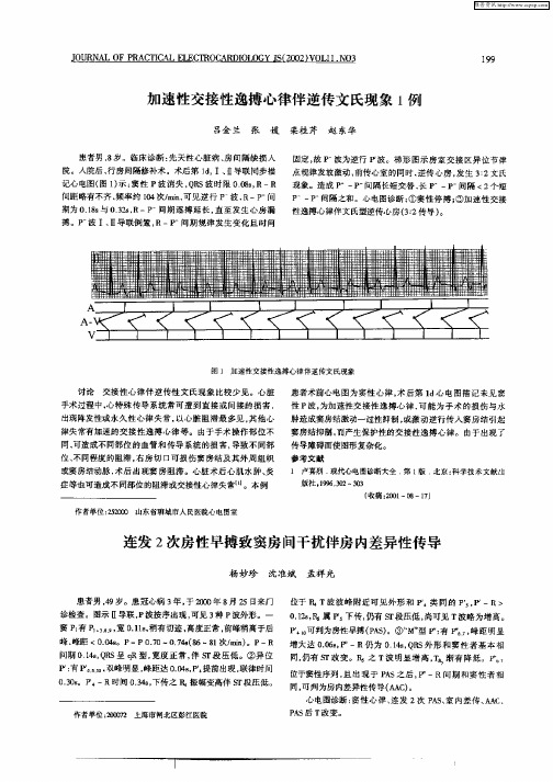 连发2次房性早搏致窦房间干扰伴房内差异性传导