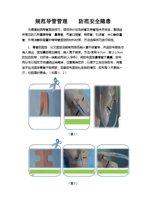 导管固定