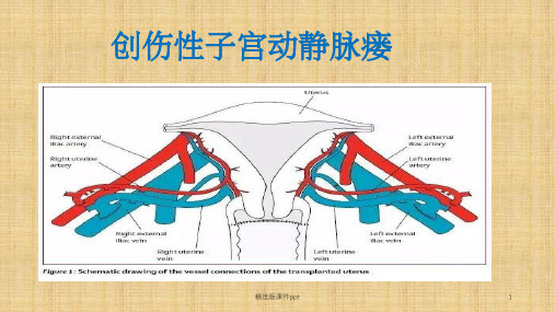 子宫动静脉瘘