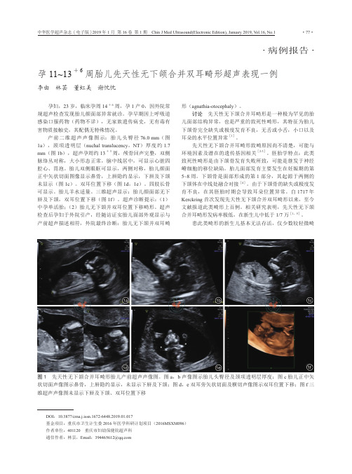 孕11~136周胎儿先天性无下颌合并双耳畸形超声表现一例