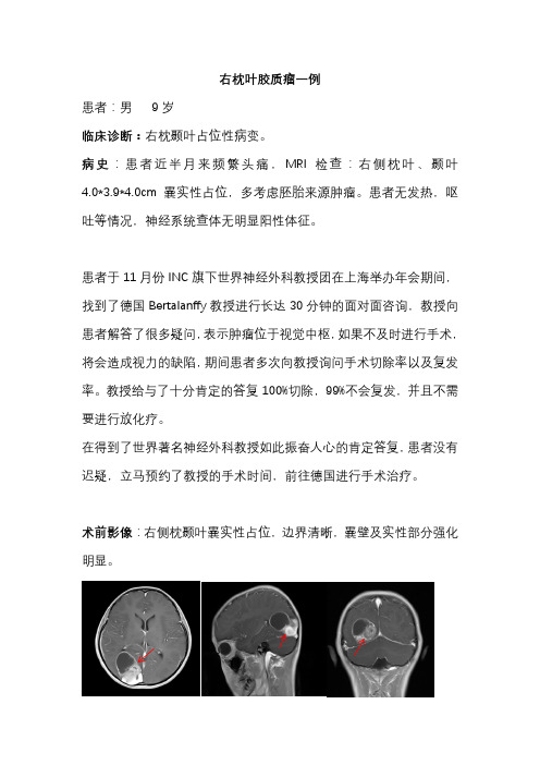右侧枕颞叶胶质瘤