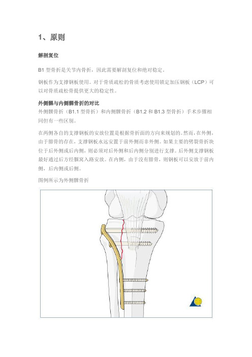 手术-胫骨平台B1型骨折内固定术
