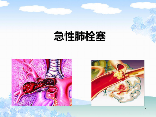 急性肺栓塞诊治与护理