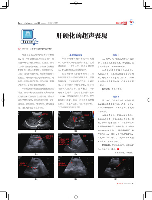 肝硬化的超声表现