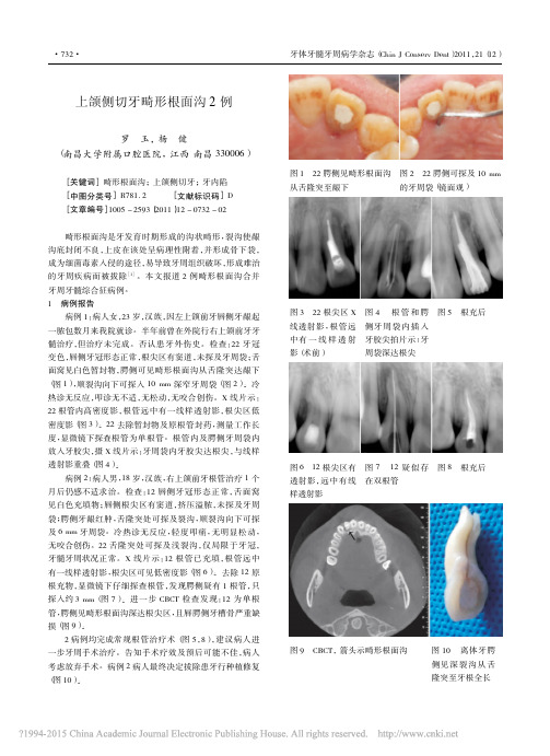 上颌侧切牙畸形根面沟2例