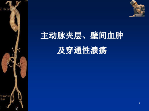 主动脉夹层、壁间血肿及穿通性溃疡的影像诊断与鉴别诊断PPT参考课件
