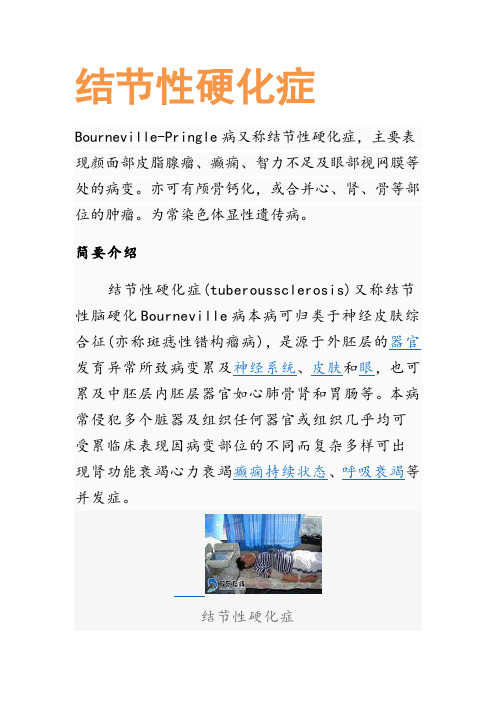结节性硬化症
