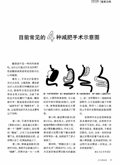 目前常见的4种减肥手术示意图