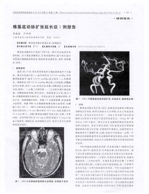 椎基底动脉扩张延长症1例报告