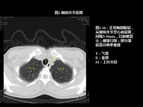 胸部CT图片ppt课件